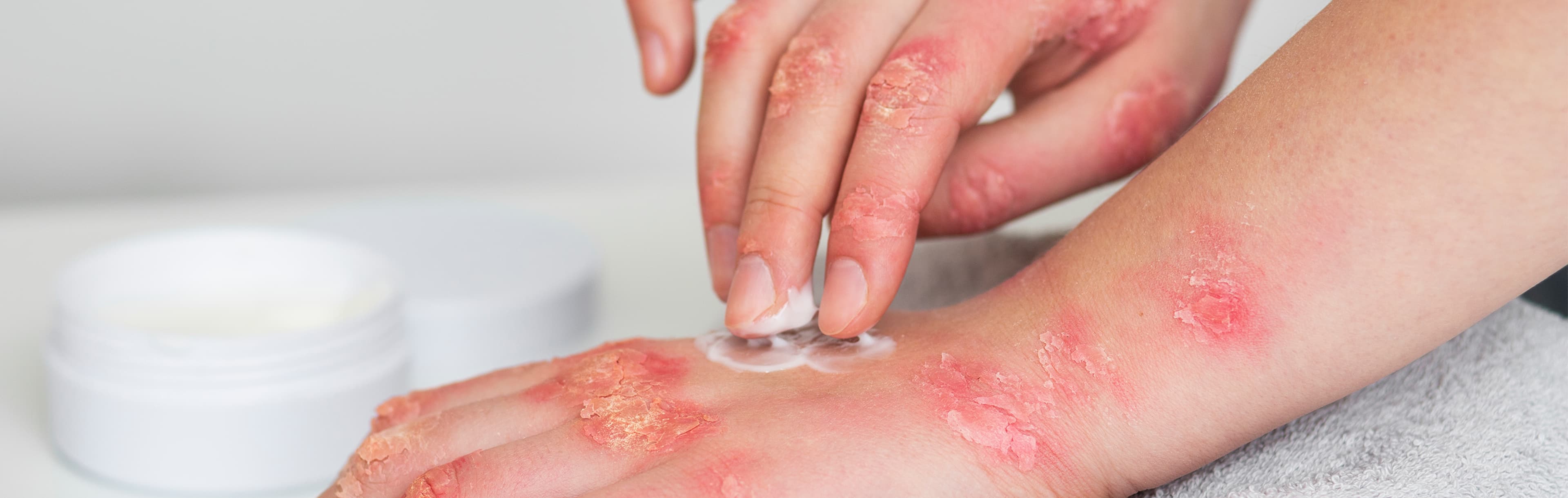 Lyme Disease Has Subtle Clinical Clues